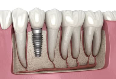 Dental İmplant
